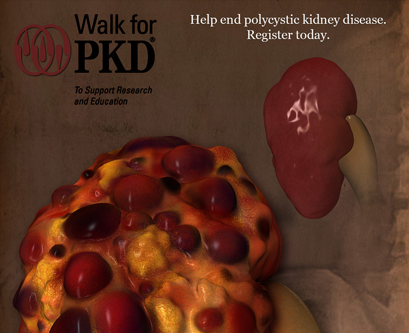 Polycystic Kidney